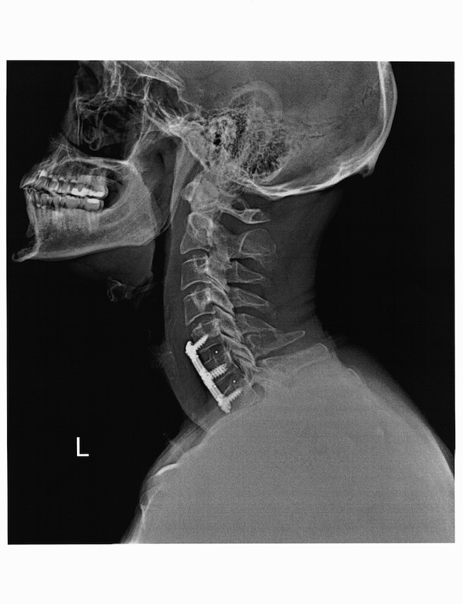 234 Cervical Fusion Isn't Some New Form Of Music